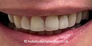 Invisalign Case