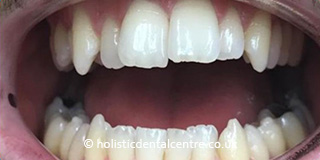 Invisalign Case