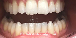 Invisalign Case