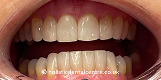 Invisalign Case